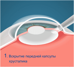 Современная методика лечения катаракты, этапы операции