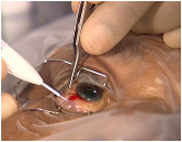 Интравитреальная инъекция Озурдекса проводится в условиях  стерильной операционной 
